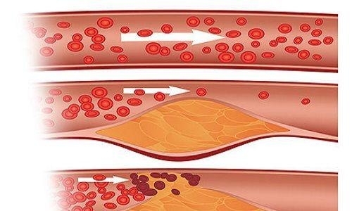 膽固醇高有什么危害？警惕“壞膽固醇”越界，“糊住”血管(圖1)