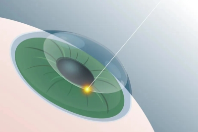 愛爾眼科：經常熬夜玩手機，可以做近視手術嗎？(圖2)