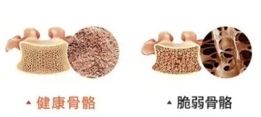 科普氨糖軟骨素鈣片養護原理及氨糖軟骨素鈣片正確吃法(圖4)